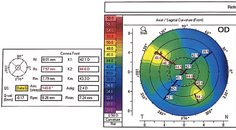Cataract and Glaucoma After Penetrating Keratoplasty