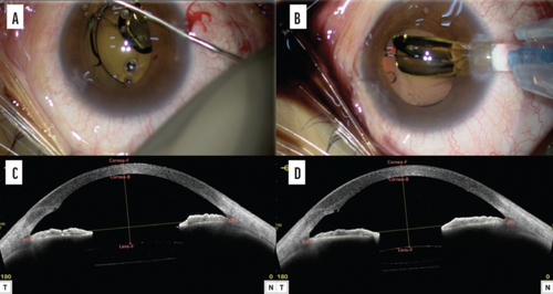 Preserving IOL Exchangeability in Cataract Surgery