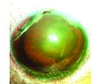 Posttraumatic Subluxated Cataract and Iris Defect