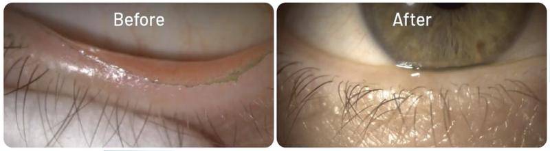Effectively Treating Demodex Blepharitis