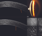Punctiform and Polychromatic Pre Descemet Corneal Dystrophy