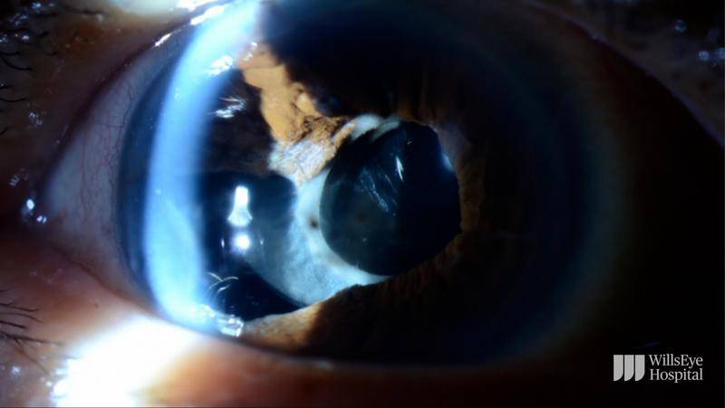 Iris Repair Following Complicated Cataract Surgery thumbnail