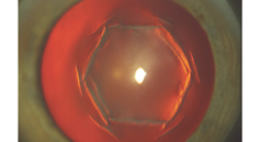 Poor Vision After Hexagonal Keratotomy