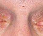 Combined PKP Artificial Iris and Secondary IOL Implantation for Corneal Scar Aniridia and Aphakia Post Traumatic Eye Inju