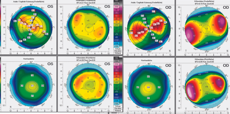 Extreme Hyperopic Astigmatism