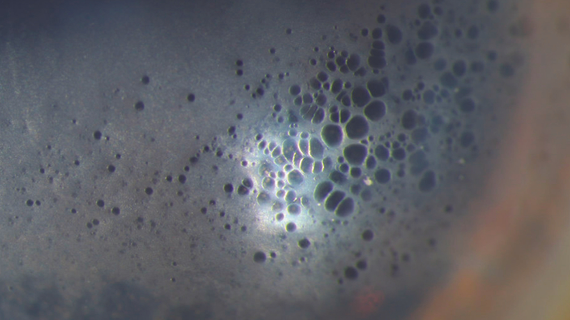 Corneal Changes After IOL Exchange