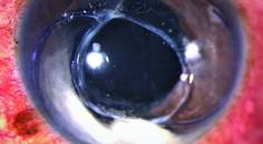 IOLCapsular Bag Complex in the Anterior Chamber