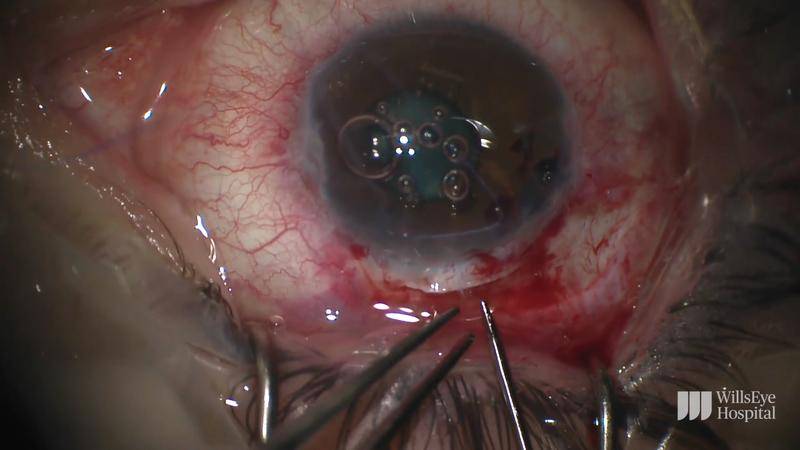 Combined Surgery in the Eye of a Patient With WeillMarchesani Syndrome thumbnail