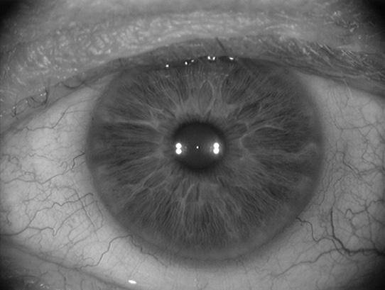 The Current Cataract Refractive Landscape