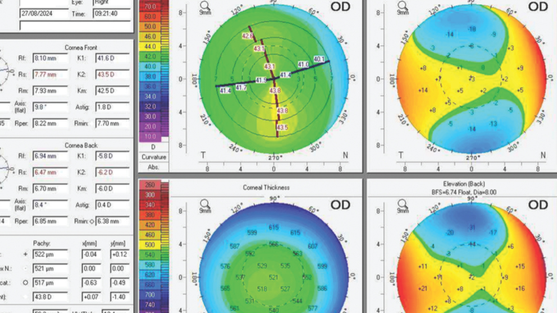Anisometropia and a Unilateral Congenital Cataract