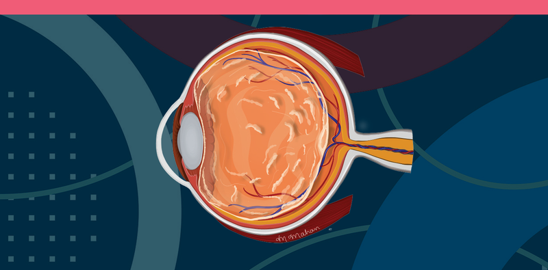 Best Practices on Referring Patients With Symptomatic Vitreous Opacities