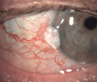 Chemotherapeutics in Eye Care Ocular Surface Squamous Neoplasia