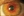 Figure 2. On primary gaze, the scleral microinserts are nearly invisible.