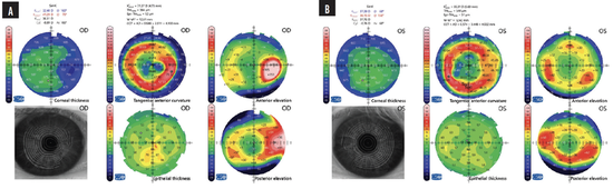 More Than 20 Radial Keratotomy Incisions