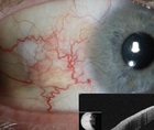 Ocular Surface Squamous Neoplasia in an Avid Sailor With Poor Compliance to Sun Protective Measures