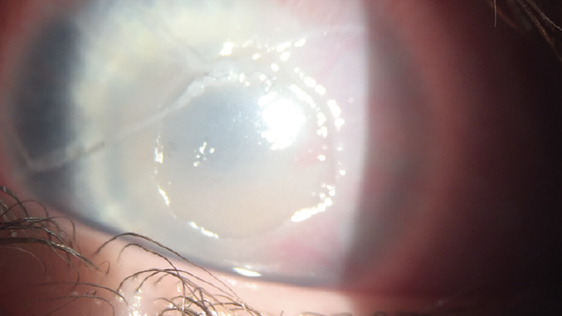 A Complex Case of Treatment Resistant Pediatric Neurotrophic Keratitis