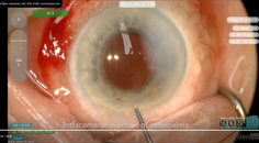 Suprachoroidal Hemorrhage