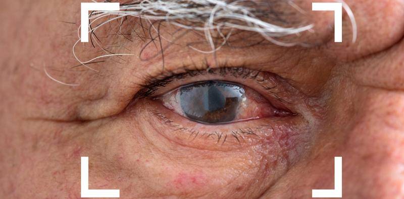 Chronic Inflammation After Cataract Surgery