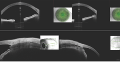 The Role of Anterior Segment OCT in MIGS