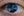 Figure 1. Clinical examination of the patient’s right eye showed an inferior iris defect and a white cataract.
(All images courtesy of Brandon D. Ayres, MD)