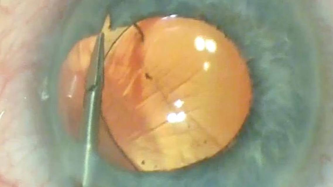 Iris Coloboma