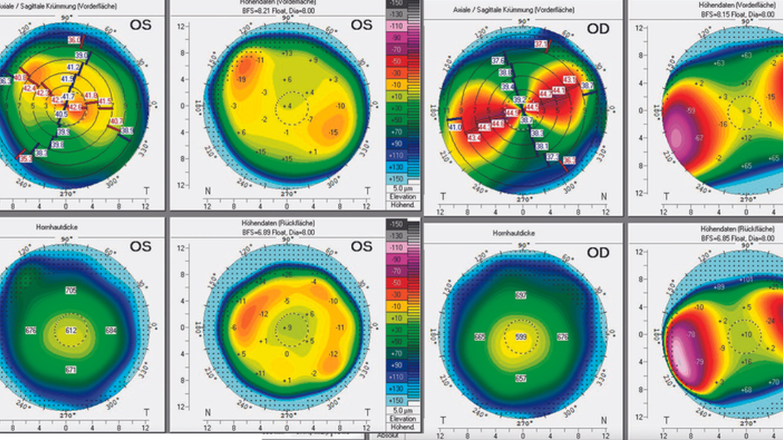 Extreme Hyperopic Astigmatism