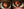 Figure 1. Inferior displacement and rotation of the sulcus-stabilized Visian Toric ICL in each eye.