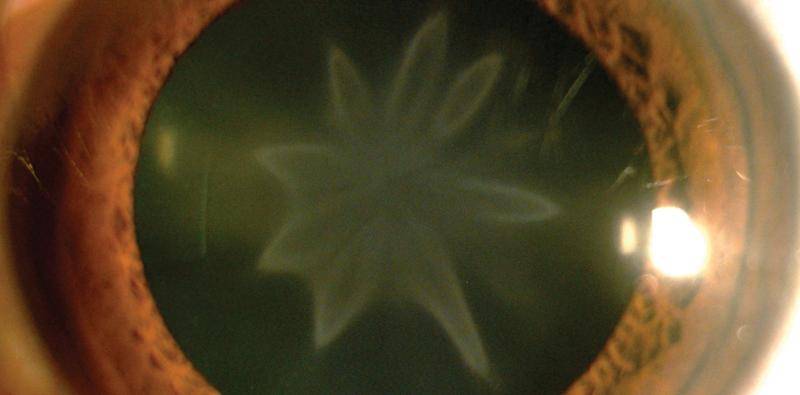 Star Shaped Cataract