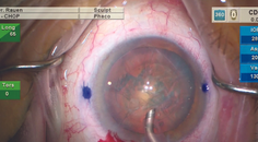 Low IOP Cataract Surgery