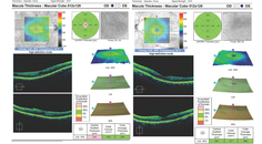 Epithelial Basement Membrane Dystrophy and Ocular Surface Disease