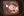 Figure 1. The patient presented with a traumatic
cataract of long standing.