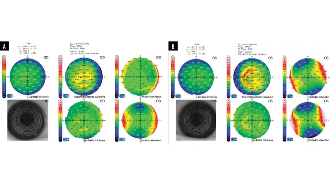 Visually Significant Cataract in the Presence of Corneal Disease