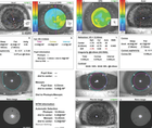 Decreased Vision From Thygeson Superficial Punctate Keratitis