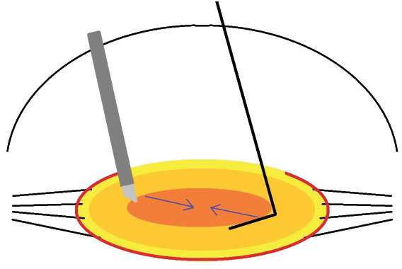 Zonulopathy and the Dense Cataract
