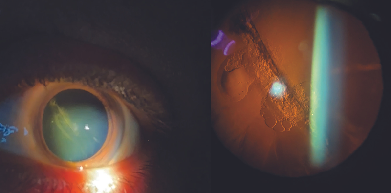 Traumatic Cataract Secondary to Needle Puncture for Intravitreal Injection