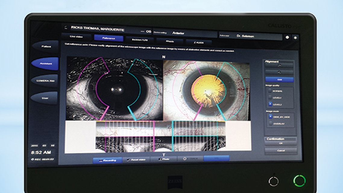 CALLISTO eye Versus Intraoperative Aberrometry