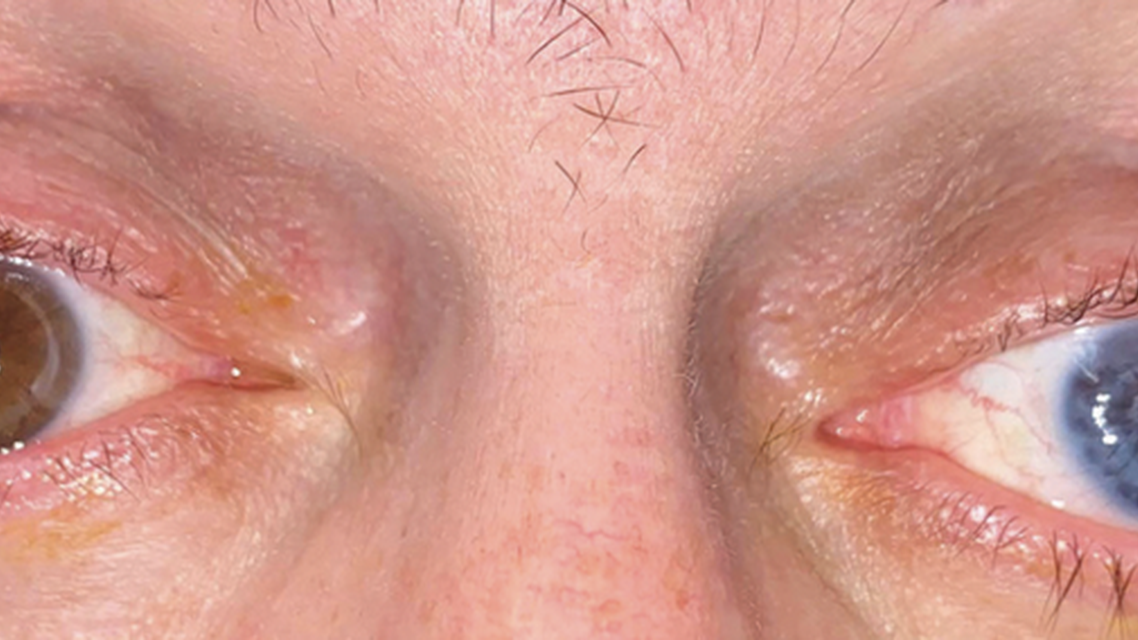 Combined PKP Artificial Iris and Secondary IOL Implantation for Corneal Scar Aniridia and Aphakia Post Traumatic Eye Inju