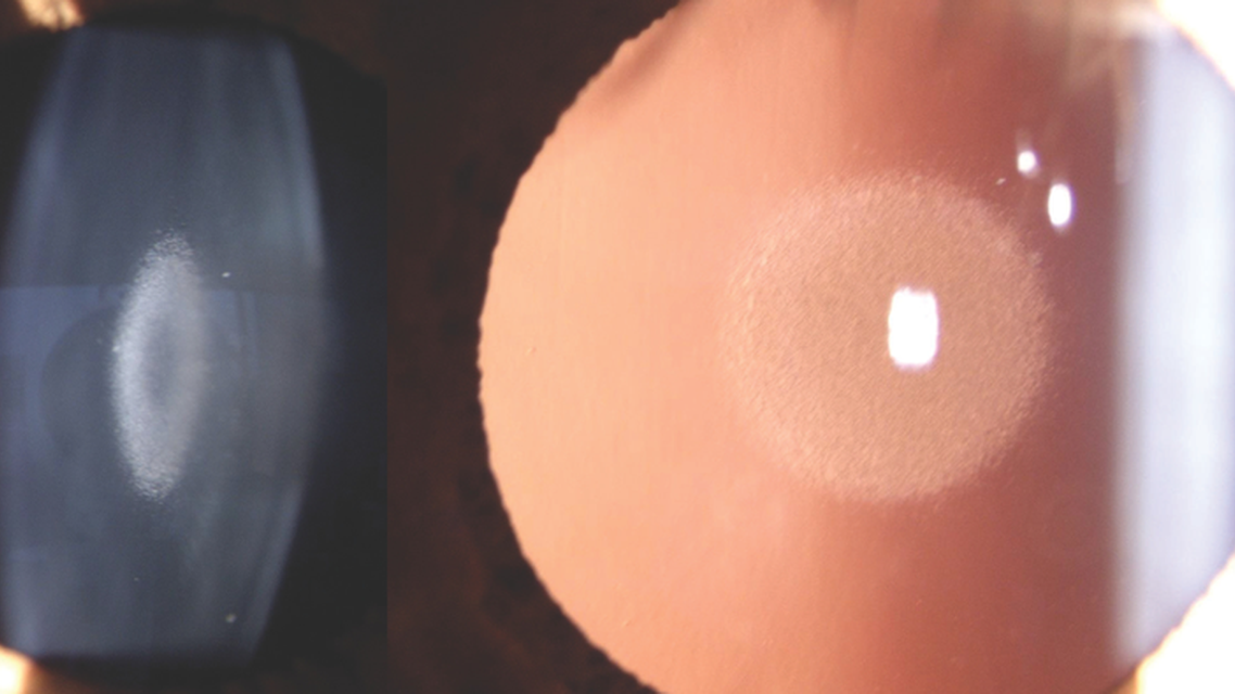 Nuclear Cataracts in a Young Adult
