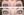 Figure. Before (A) and after (B) treatment with oxymetazoline hydrochloride ophthalmic solution 0.1%.