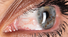 Targeting Inflammation in Dry Eye Disease