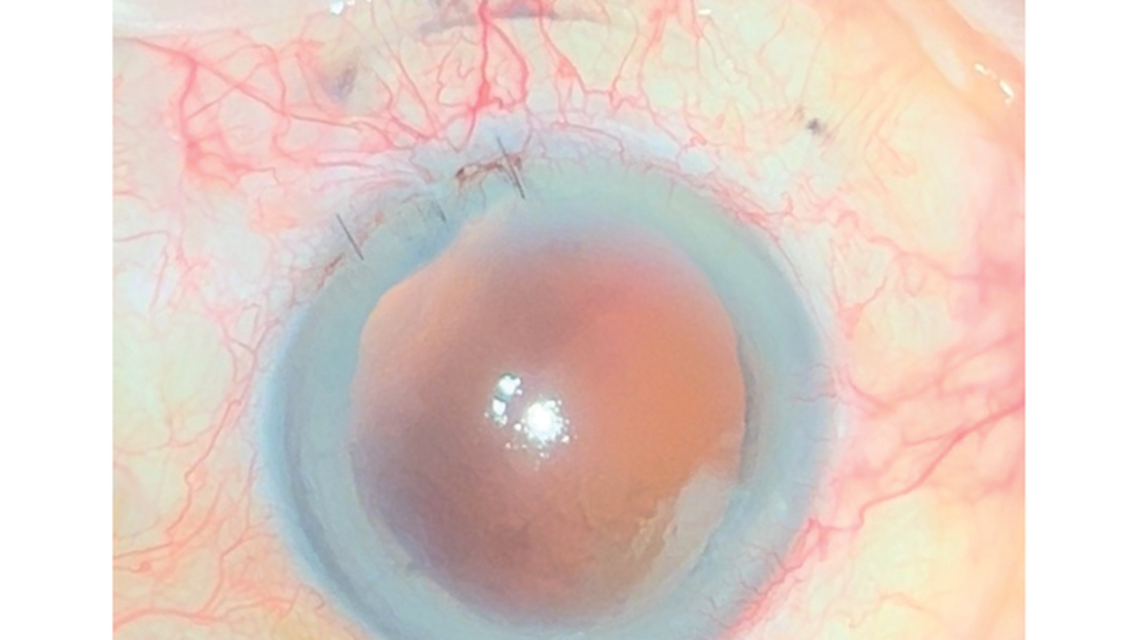 Traumatic Aphakia and Mydriasis