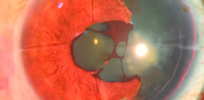 Traumatic Aniridia in a Patient With a History of Radial Keratotomy