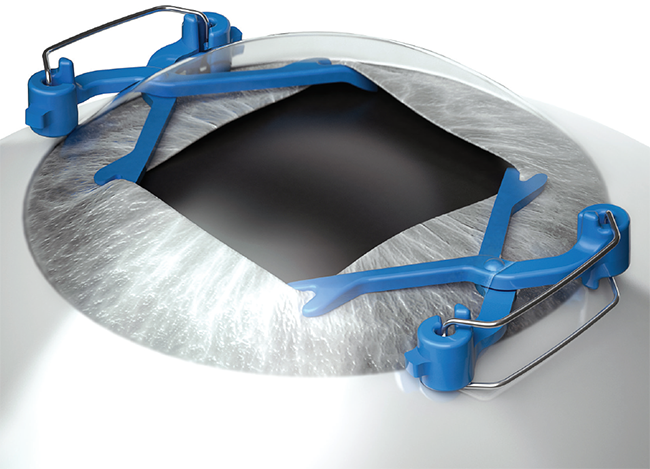 Cataract Surgery in Small Pupils