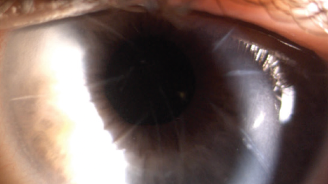 Cataract Surgery After Prior Radial Keratotomy