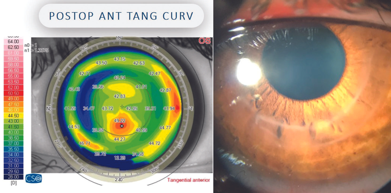Therapeutic Refractive Surgery for Keratoconus