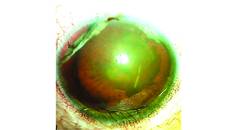 Posttraumatic Subluxated Cataract and Iris Defect