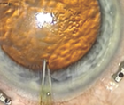 Optimizing the Incision