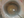 Figure 4. A laser capsulotomy is created in an eye with a
subluxated crystalline lens. Figures 4–7 courtesy of J. Morgan Micheletti, MD
