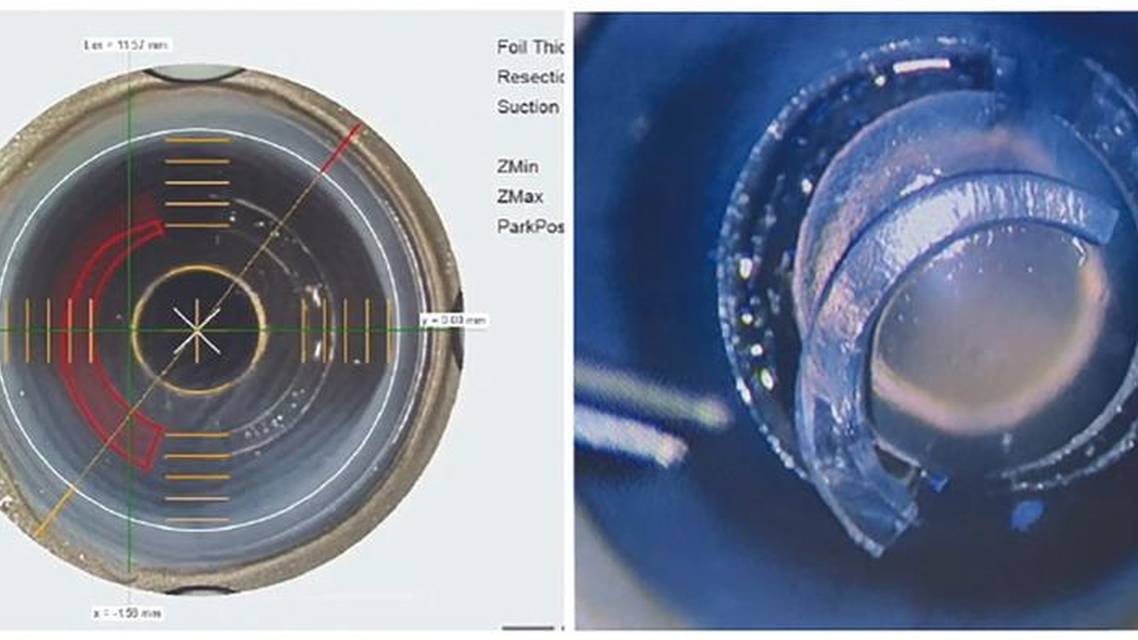 Corneal Allogenic Intrastromal Ring Segments and Customization