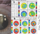Comorbid Cataract and Macular Hole